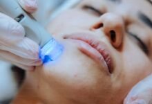 5 Ways Laser Treatment Is The Best Solution For Your Skin's Hyperpigmentation 