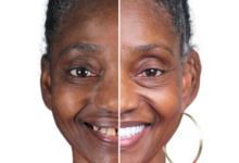 How Dental Implants Help Preserve What Natural Teeth Cannot