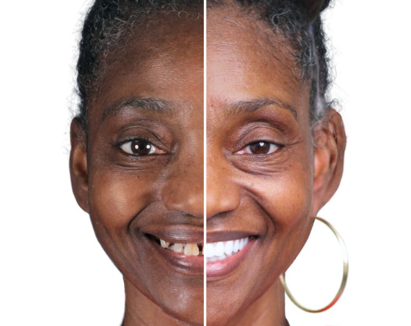 How Dental Implants Help Preserve What Natural Teeth Cannot